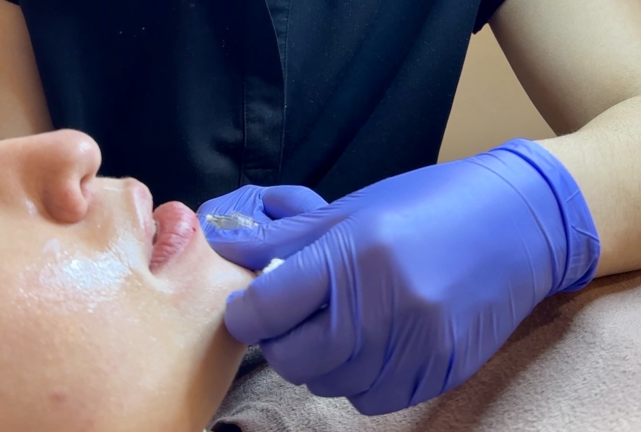 Consulta de relleno de labios y armonización facial